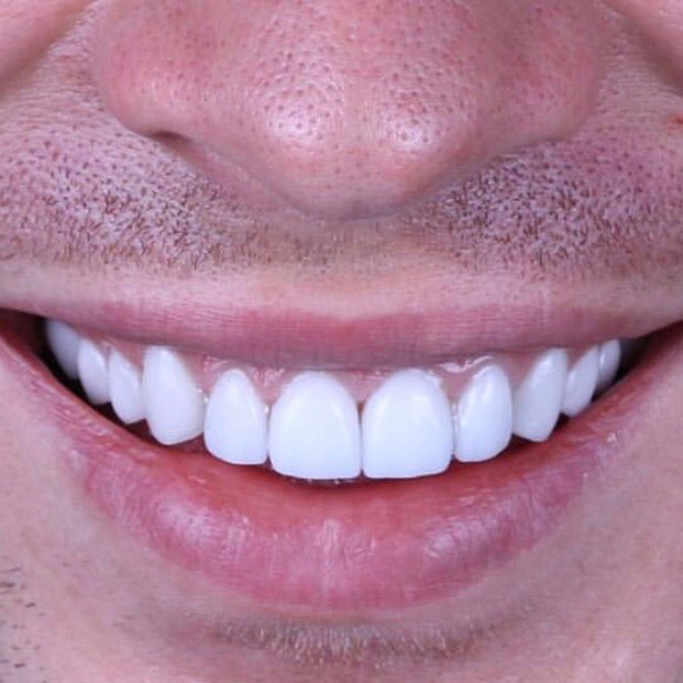 too white teeth